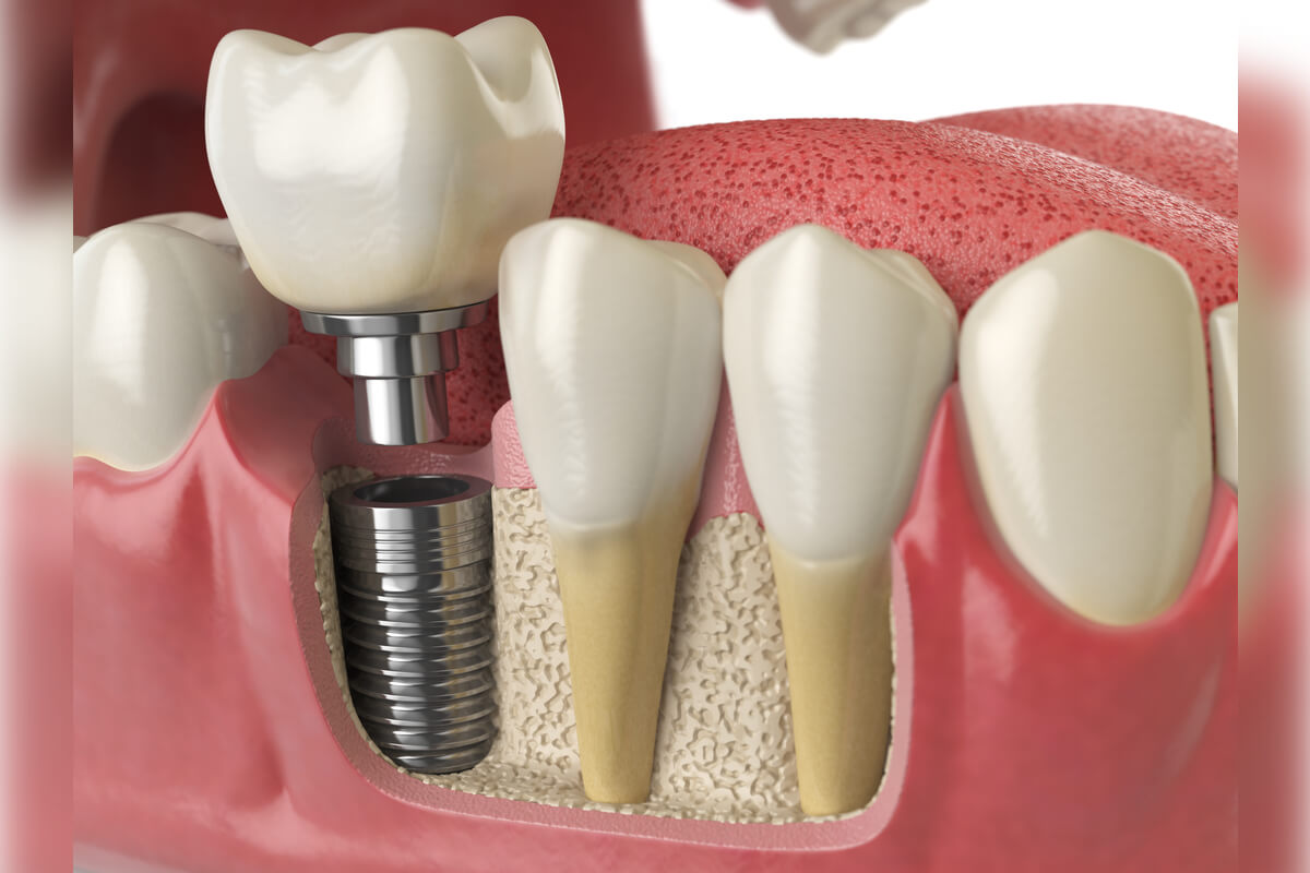 Affordable All-on-4 Dental Implants - The image illustrates a cross-sectional view of a dental implant procedure, specifically showcasing the All-on-4 dental implant system. A dental implant is being securely placed into the jawbone to serve as a foundation for a replacement tooth. The implant, made of titanium, is positioned beneath the gum line and integrated into the bone, providing a stable base for the crown above. Surrounding natural teeth and gum tissue are visible, emphasizing the precise placement of the implant, which is designed to restore dental function and aesthetics affordably. This type of procedure is often chosen for its effectiveness in supporting multiple teeth with minimal implants, enhancing the patient's smile and oral health.