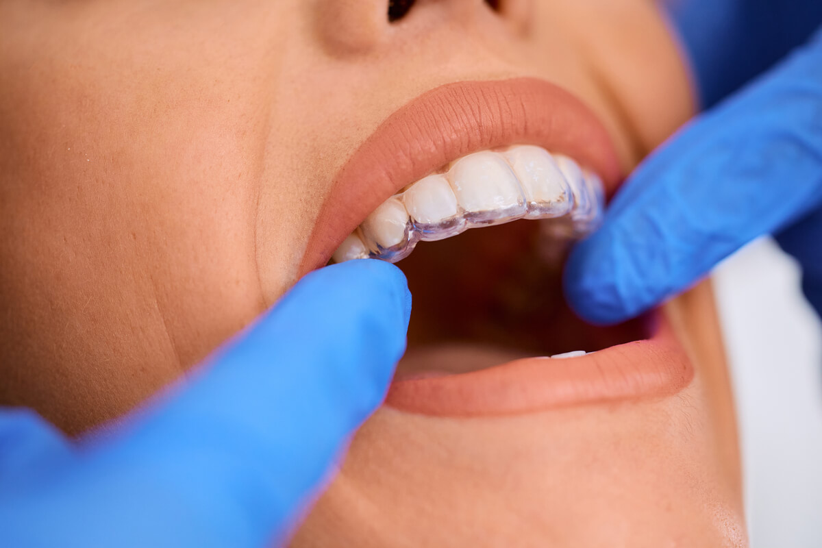 Affordable Clear Aligners for Adults - A close-up view of a dental professional adjusting clear aligners on a patient's upper teeth. The patient’s mouth is open slightly, allowing the professional, wearing blue gloves, to ensure the aligners fit perfectly. The clear aligners are almost invisible against the patient’s teeth, showcasing their effectiveness and discreetness as an affordable orthodontic solution for adults. The image emphasizes the precise fit and comfort that clear aligners provide, making them a popular choice for adults seeking to straighten their teeth without the visibility of traditional braces.