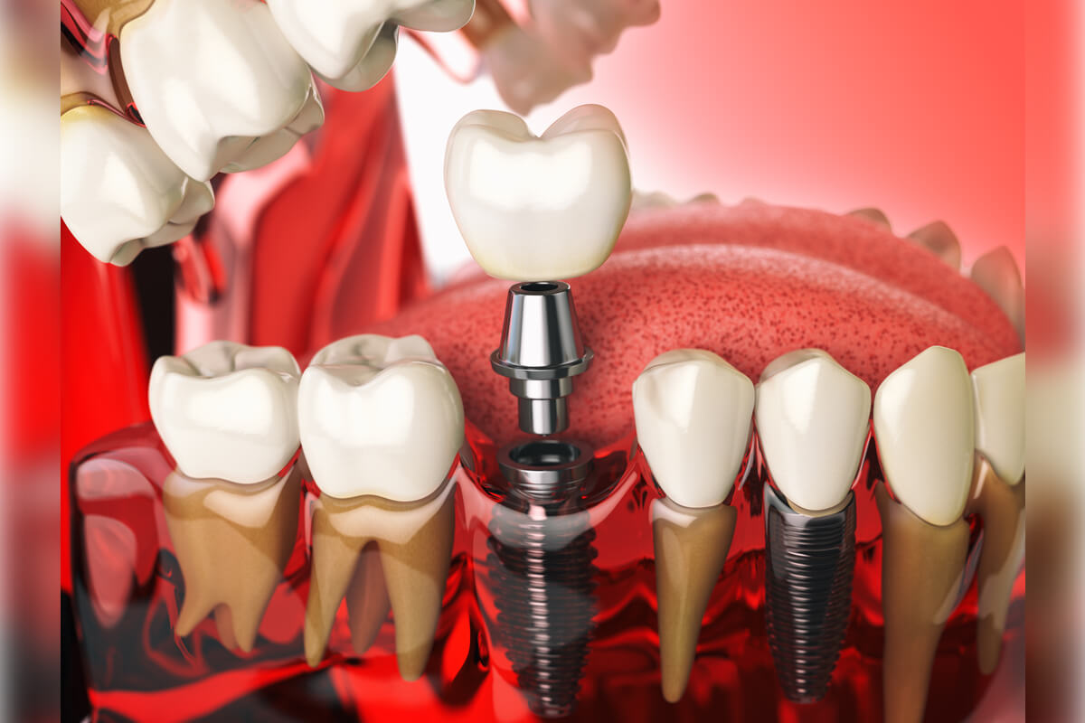 All-on-4 Dental Implants Near Me - A detailed 3D rendering illustrates a dental implant procedure in progress. The image showcases a metal implant screw inserted into the jawbone, representing the foundation for the artificial tooth. Above the screw, an abutment is placed, onto which a dental crown is being secured. The surrounding teeth and gum tissue are clearly visible, emphasizing the precision and care required in dental implant surgery. This process, often sought in All-on-4 dental implant treatments, aims to replace missing teeth and restore oral functionality and aesthetics. The vibrant colors and detailed anatomy highlight the advanced techniques used in modern dental implantology.