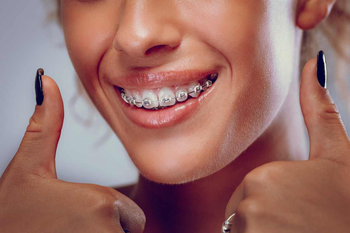 Braces-Friendly Diet - A close-up image of a person smiling with metal braces on their teeth, showcasing a healthy and confident smile. The individual is giving a thumbs-up gesture, symbolizing positivity and satisfaction. The image emphasizes the importance of a braces-friendly diet to maintain oral health and comfort during orthodontic treatment. With well-maintained braces, the person demonstrates the potential for achieving straight teeth and improved dental alignment. The setting appears bright, highlighting the shiny metal of the braces and the person's clear, healthy skin.