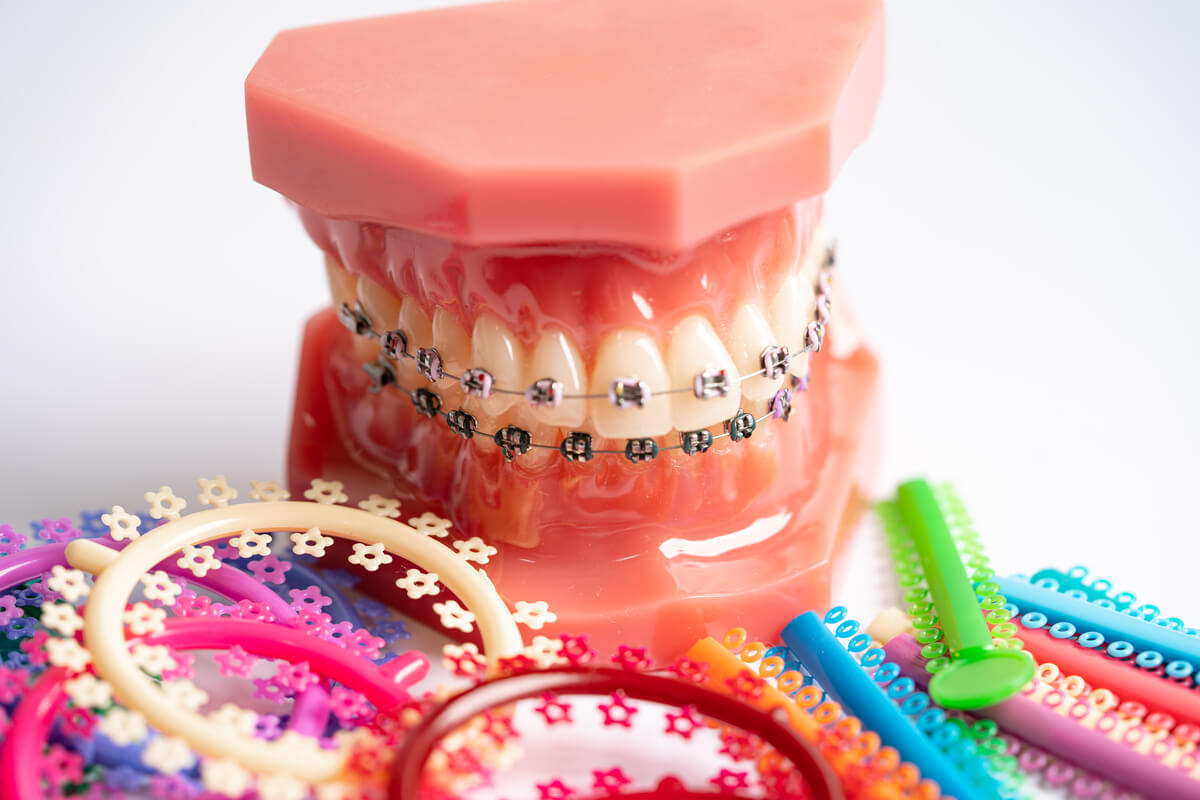 Cost of Braces for Adults - The image features a dental model showcasing a full set of teeth fitted with traditional metal braces, highlighting the precision involved in orthodontic treatment. Surrounding the model are various colorful orthodontic elastics, often used to adjust and customize braces during treatment. These elastics are available in a variety of shapes and colors, allowing for personalization of the braces, a factor that can contribute to the overall cost. The clean, white background emphasizes the focus on the dental model, symbolizing the investment adults may consider for achieving proper teeth alignment and an improved smile through orthodontic care. This image underscores the elements that influence the cost of braces for adults, including materials, customization options, and treatment duration.