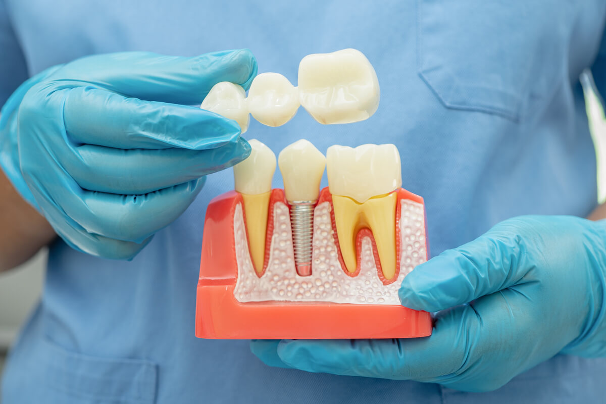 Dental Bridges - A dental professional wearing blue scrubs and gloves is holding a model of a dental bridge. The model showcases a dental implant procedure, with an artificial tooth being placed onto an implant in the jawbone. The implant serves as a stable base to support the dental bridge, which replaces missing teeth. This visual demonstrates how dental bridges help restore proper bite function, improve aesthetic appearance, and maintain the integrity of the patient's dental structure. The setting appears to be a clinical environment, likely a dental office, emphasizing the importance of dental care and oral health.