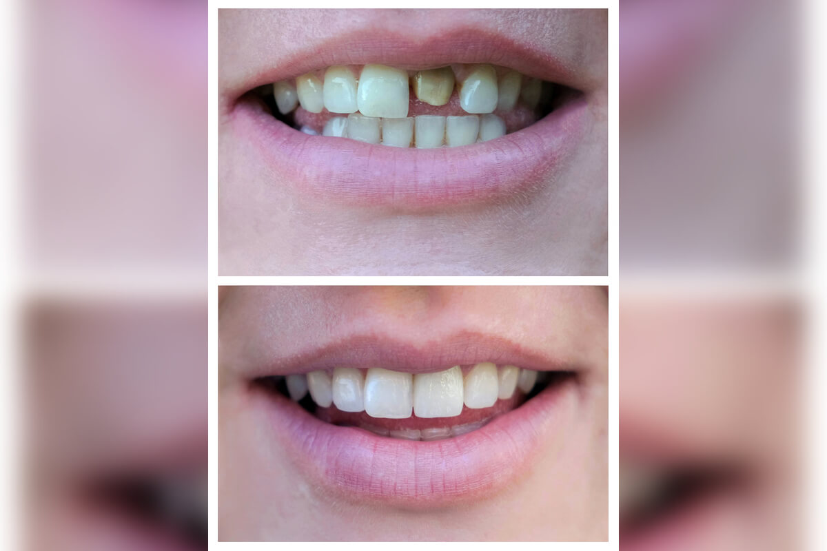 Dental Crown - The image depicts a before-and-after scenario showcasing the results of a dental crown procedure. In the top part of the image, the person's teeth appear discolored and uneven, with one tooth prominently stained and showing signs of decay. In the lower part of the image, the same individual's smile reveals a significant improvement. The teeth now look whiter, more uniform, and healthier, indicating the successful placement of dental crowns. This cosmetic and restorative dental treatment has enhanced the appearance of the patient's smile, reflecting the benefits of using dental crowns to cover damaged or discolored teeth, restore function, and improve aesthetic appeal.