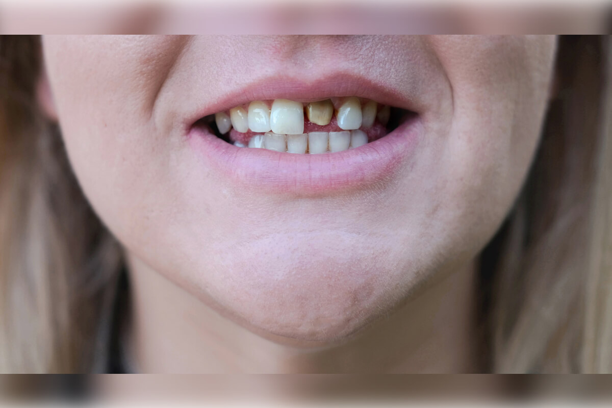 Dental Crown - A close-up image highlighting a patient's dental condition before undergoing a dental crown procedure. The person's teeth are visibly stained, with one tooth showing significant discoloration and decay, indicating a need for restorative dental treatment. This condition suggests the importance of using dental crowns to cover and protect damaged teeth, prevent further decay, and restore the natural look and function of the smile. The image captures the challenges of dental health issues such as enamel erosion and tooth decay, emphasizing the role of dental crowns in improving oral hygiene and overall appearance.