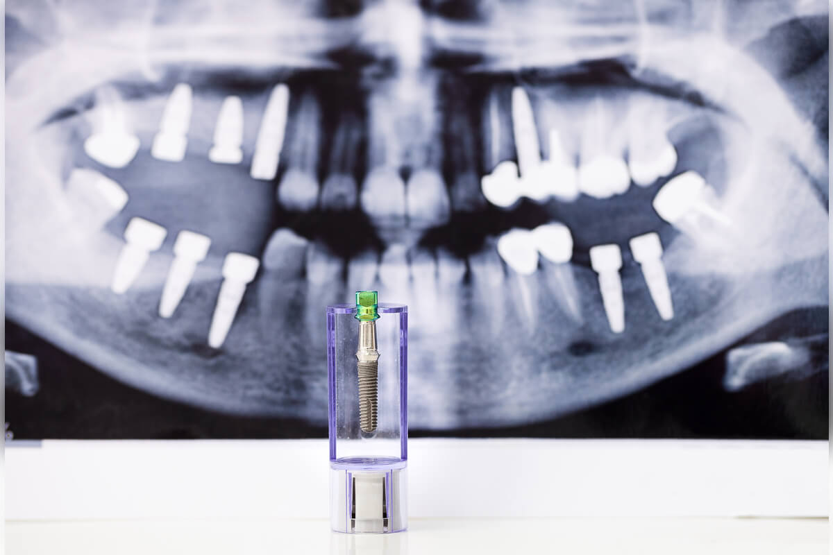 Dental Implants - The image shows a dental implant model in the foreground, positioned in front of an X-ray image of a patient's jaw. The X-ray reveals several dental implants integrated into the jawbone, replacing missing teeth. The metal implant in the model resembles those visible in the X-ray, indicating its use for replacing lost teeth. This setup is commonly found in dental clinics, where such models are used to educate patients about the dental implant procedure and its role in restoring dental function and aesthetics.