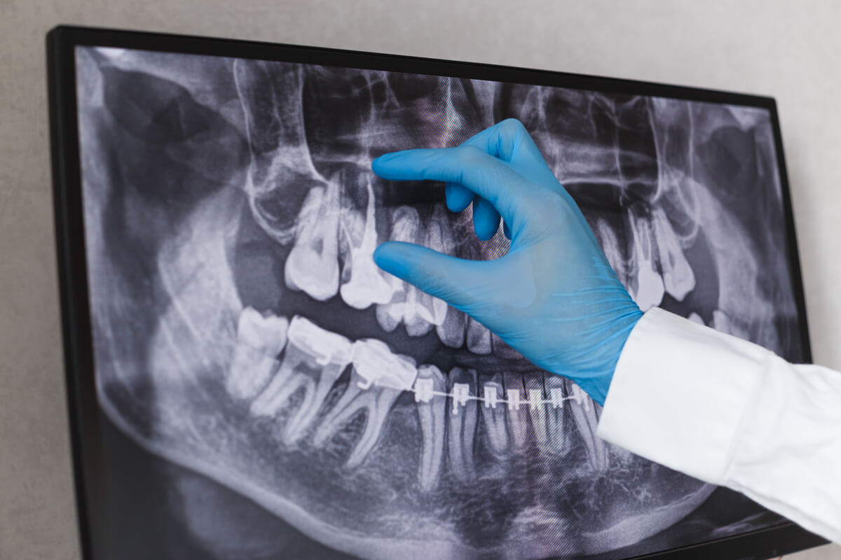 Dental X-Ray Services - A close-up image of a dental professional's gloved hand pointing at a detailed dental X-ray displayed on a screen. The X-ray clearly shows the patient’s teeth, jawbone, and dental work, including braces on the lower teeth. The dental professional is likely discussing the X-ray results with the patient, emphasizing the importance of Dental X-Ray Services in diagnosing and planning dental treatments. The clinical setting is focused on precision and clarity, ensuring accurate assessment and effective care for dental patients.