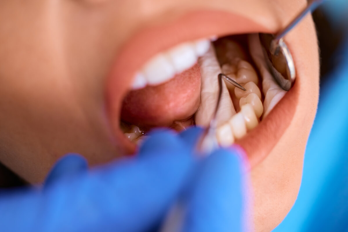 Inlays and Onlays - A detailed close-up of a dental procedure showing a dentist examining a patient's molar using a dental explorer tool. The focus is on the precise preparation of the tooth for an inlay or onlay restoration, a process that involves removing decay and shaping the cavity to fit the custom-made restoration perfectly. This procedure, performed under sterile conditions with the dentist wearing protective gloves, aims to restore the tooth’s strength and functionality while preserving its natural appearance. The use of a dental mirror and explorer highlights the precision required for accurately placing inlays and onlays, which are typically made from porcelain or composite resin to match the patient’s teeth.